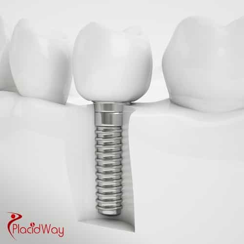 Dental Implants in Turkey: Why German Patients Choose All-on-4 Implants for a Full Smile Restoration